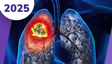 Mesotelioma